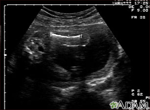 salir con un embarazo con ultrasonidos