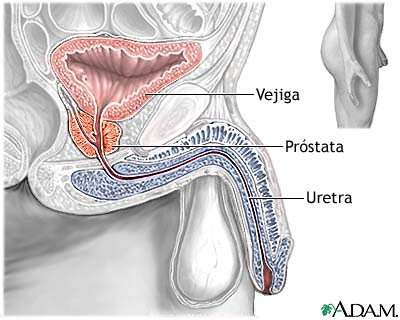 Resección transuretral de la próstata (RTUP) - Serie
