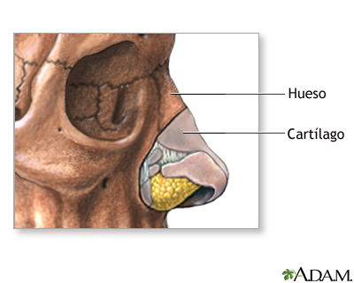 Cirugía plástica de la nariz (rinoplastia) - serie