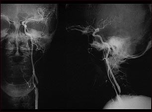 Estenosis carotídea - radiografía de la arteria izquierda
