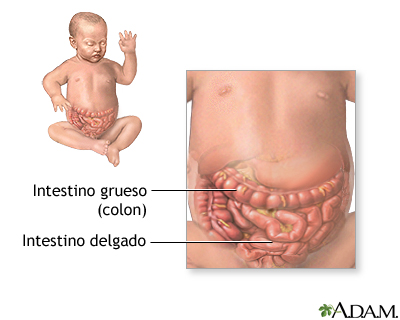 Obstrucción intestinal (pediátrico) - serie