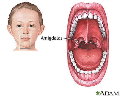 Amigdalectomía - Serie