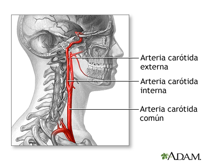 Cirugía de la arteria carótida - serie