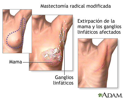 Mastectomía - Procedimiento (segunda parte)