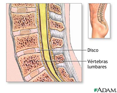 Injerto de hueso de la columna vertebral - serie