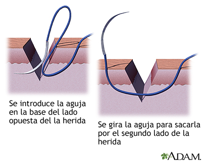 Cómo cerrar una herida por sutura (tercera parte)