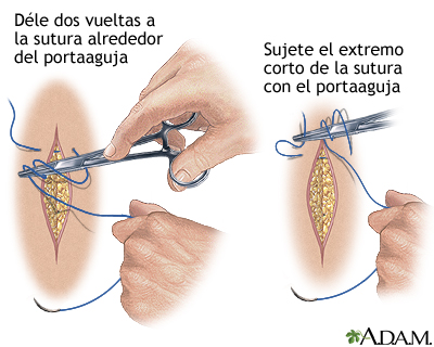Cómo cerrar una herida por sutura (quinta parte)