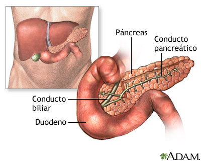 Pancreatitis - serie