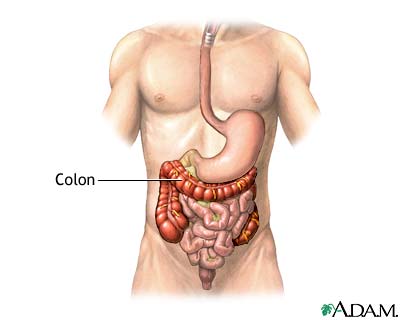 Divertículo de colon - serie