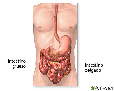 Reparación de obstrucción intestinal - serie