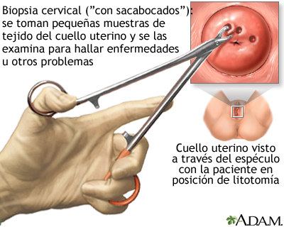 Biopsia cervical