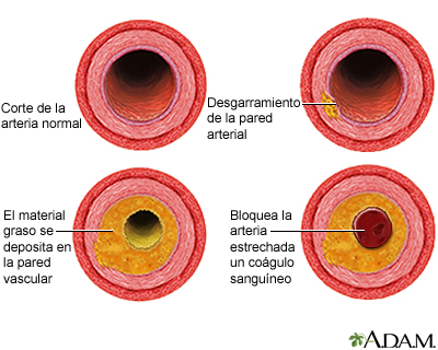 Proceso de evolución de la aterosclerosis