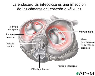 Endocarditis infecciosa