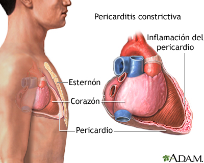 Pericarditis constrictiva