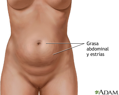 Abdominoplastia - serie
