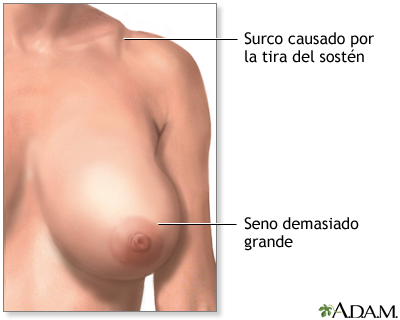 Reducción de mamas (mamoplastia) - serie - Indicaciones