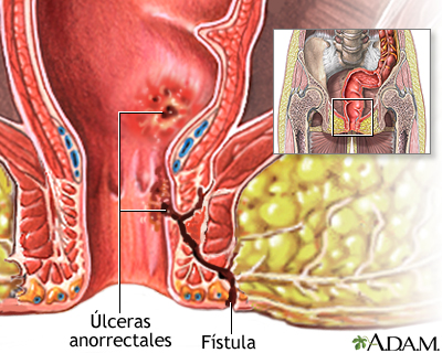 Fístulas anorrectales
