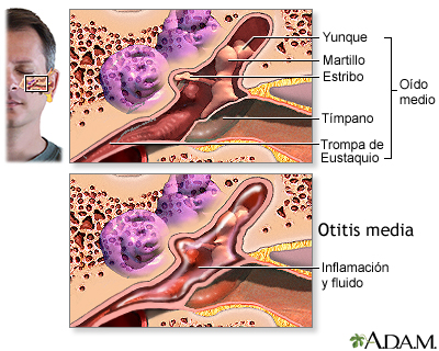 Infección del oído medio (otitis media)