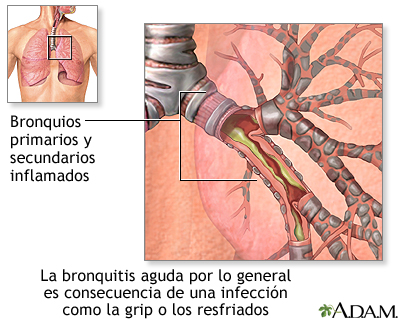 Causas de la bronquitis aguda