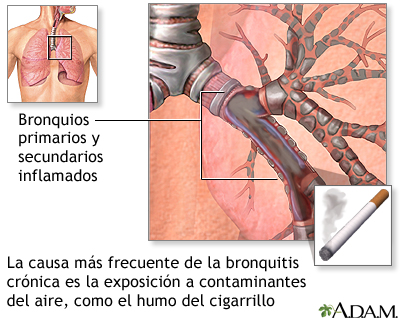 Causas de la bronquitis crónica