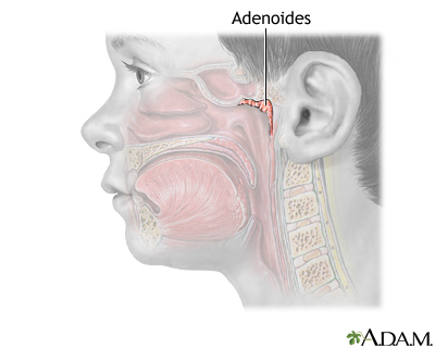 Adenoidectomía - Serie
