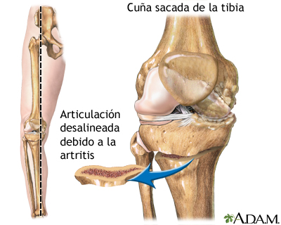 Osteotomía tibial