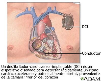 Desfibrilador-cardioversor implantable