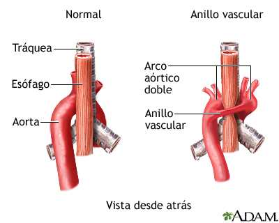 Anillo vascular