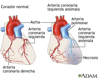 Arteria coronaria izquierda anómala