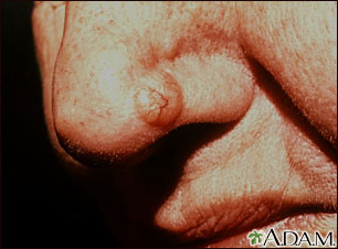 Cáncer de piel - carcinoma de célula basal en la nariz