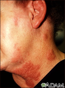 Herpes zoster (culebrilla) en cuello y mejilla