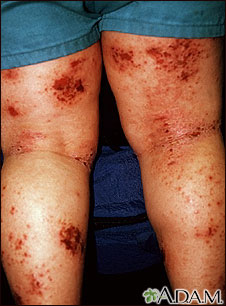 Dermatitis - atópica de las piernas