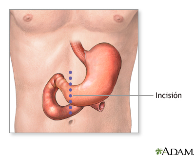 Incisión gastrotomía