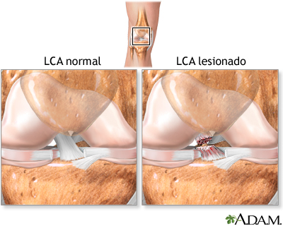 Lesión del ligamento cruzado anterior (LCA)