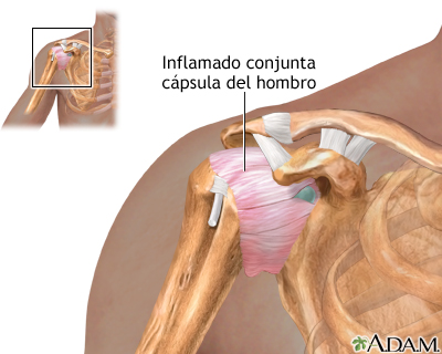 Inflamación de la articulación del hombro