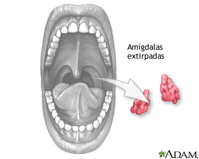 Tonsilectomía