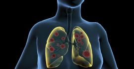 Enfermedades respiratorias agudas: cuáles son, sintomas, diagnóstico, tratamiento 