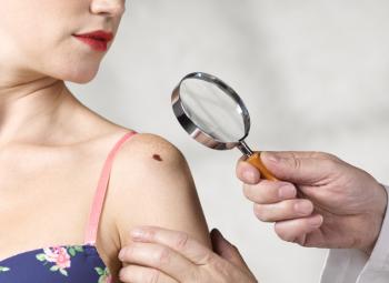 ¿What is basal cell carcinoma?