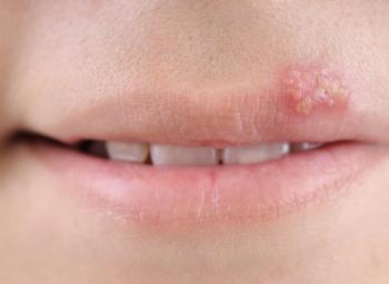 Questions and Answers About Herpes