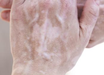 Esta mancha blanca en la  piel ¿puede ser vitiligo?