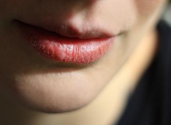 Por qué se agrietan los labios y cómo evitarlo