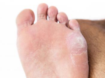10 remedios naturales para problemas comunes de los pies - 10 remedios