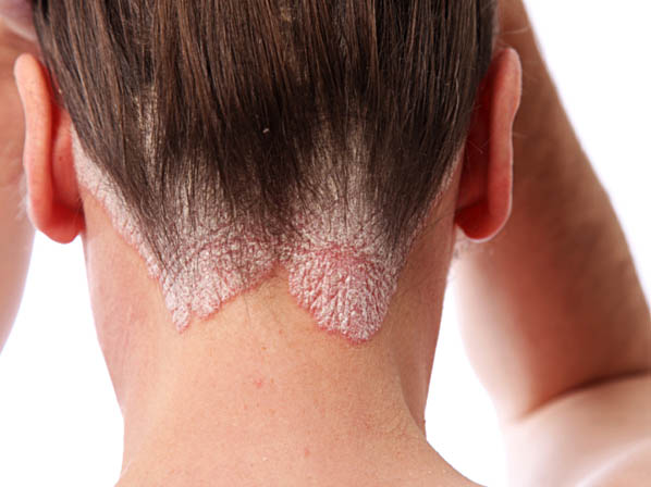 La psoriasis
