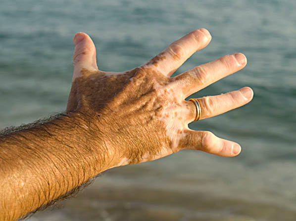 El vitiligo