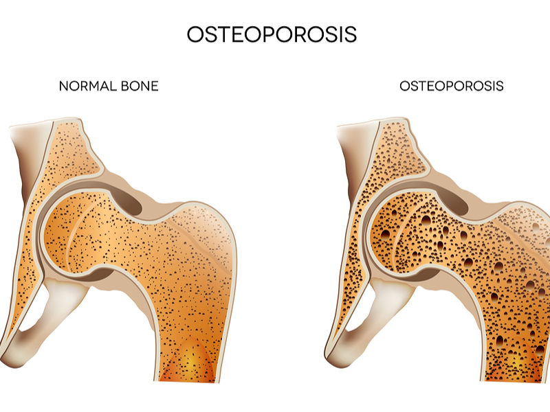 7 Causas comunes del dolor de espalda y cómo aliviarte - 4) Osteoporosis