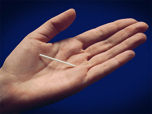Cuáles son los mejores métodos anticonceptivos - 4. Implante anticonceptivo