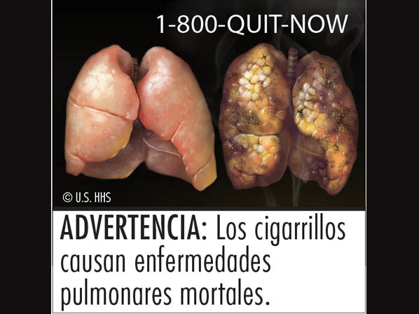 Las nueve advertencias nuevas de los cigarrillos   -  3: Los cigarrillos causan una enfermedad letal en el pulmón