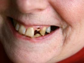 Relacionan pérdida de dientes con pérdida de memoria