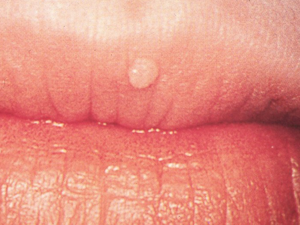 9 enfermedades trasmitidas por besos - 8. Verrugas