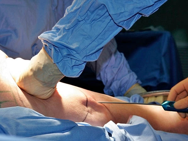 Las 10 cirugías más populares - Nº 2:  Liposucción